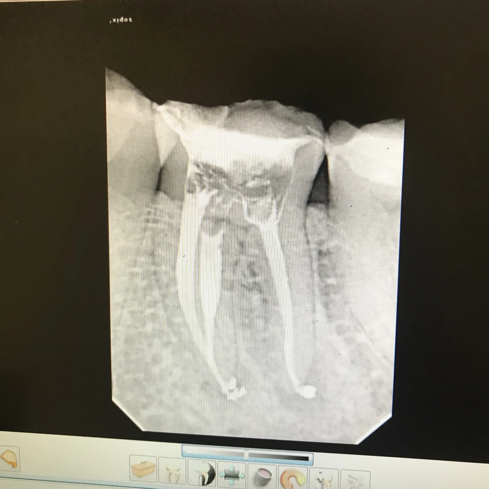 перелечивание зубов