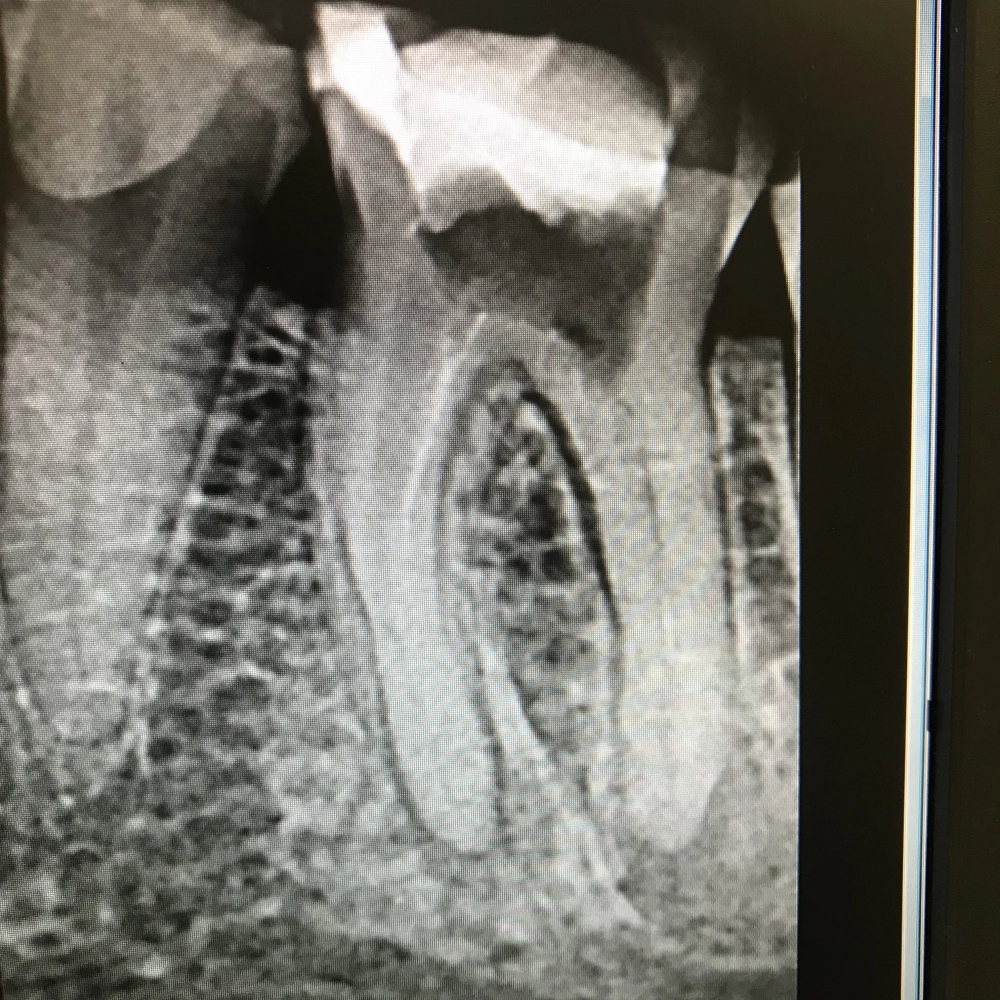 перелечивание зубов