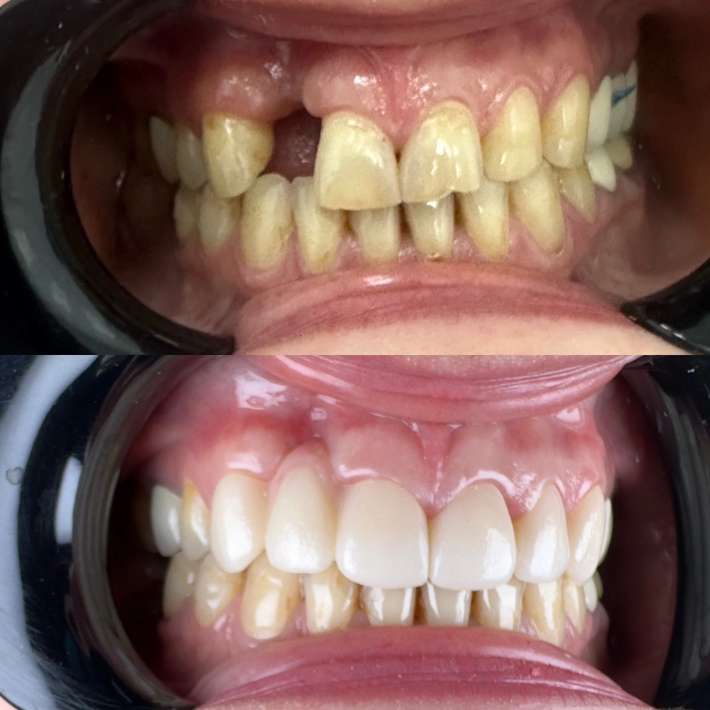 протезирвание в зоне улыбки (керамические реставрации)