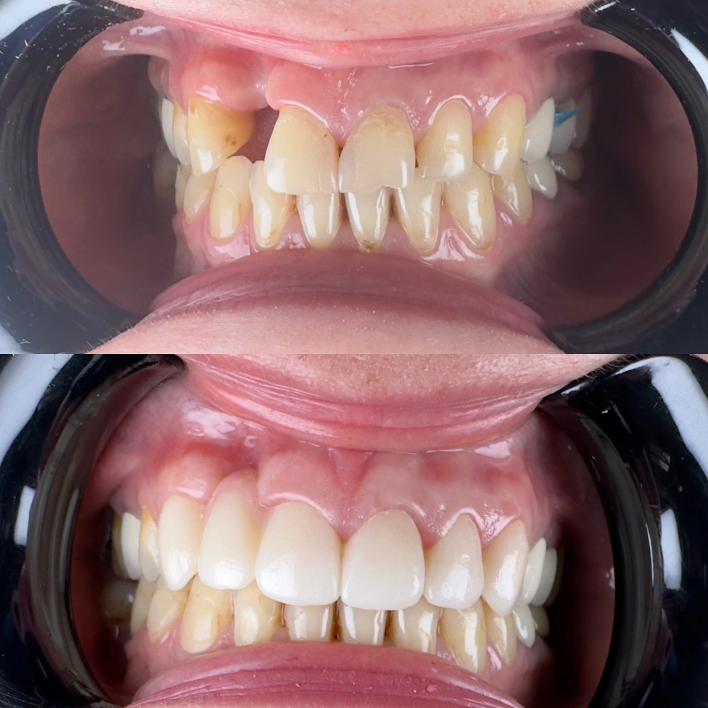 протезирвание в зоне улыбки (керамические реставрации)