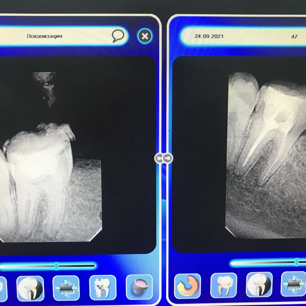 лечение зубов под микрсокопом