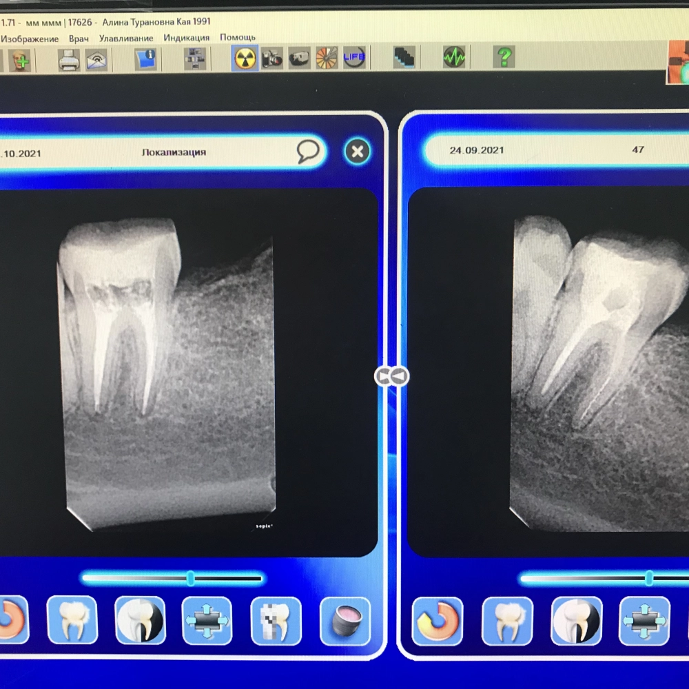 лечение зубов под микрсокопом