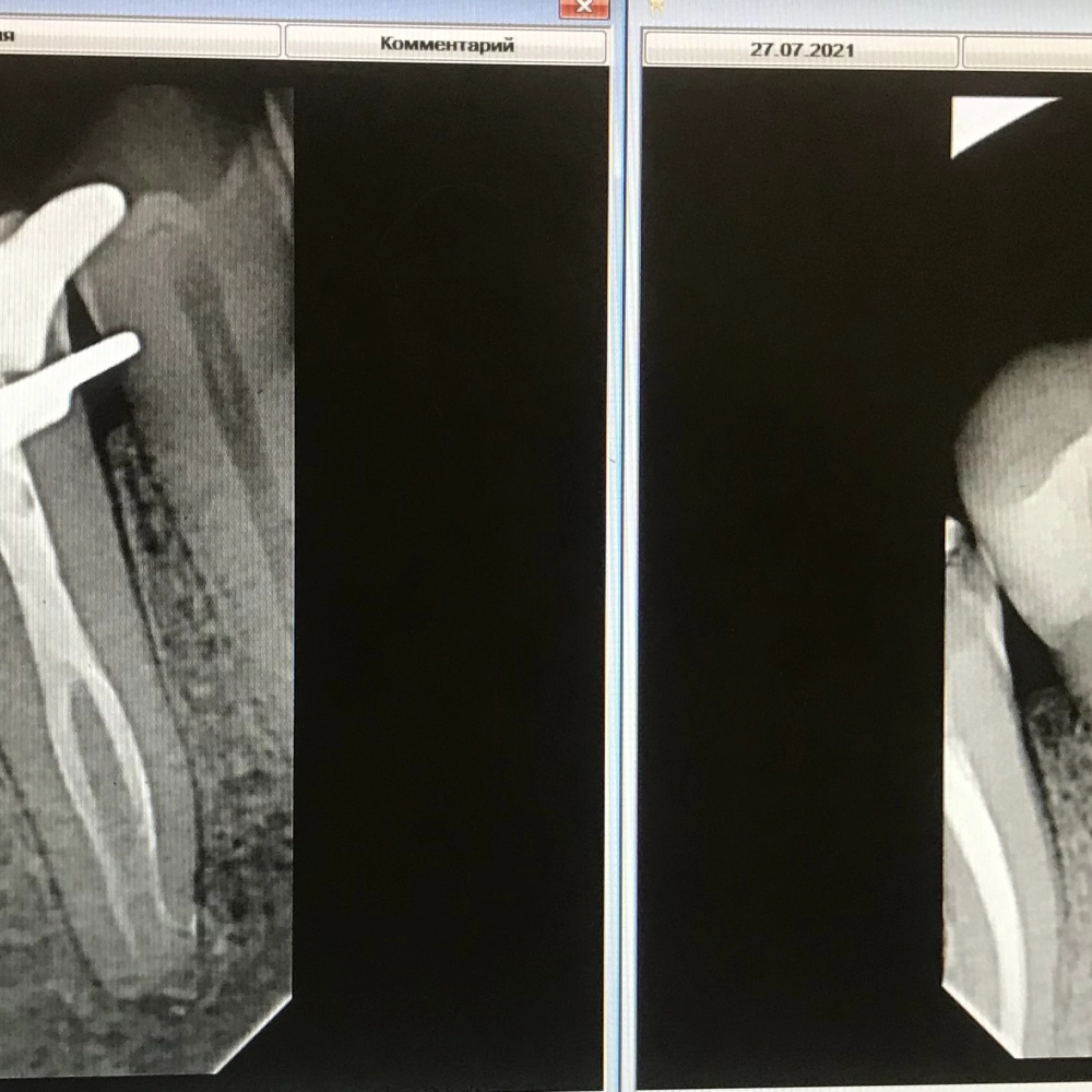 перелечивание зуба