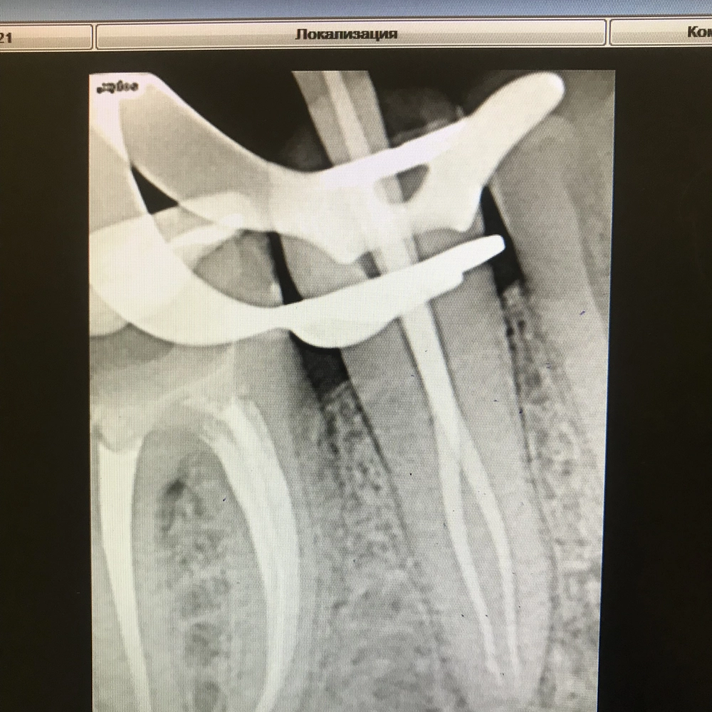 перелечивание зуба